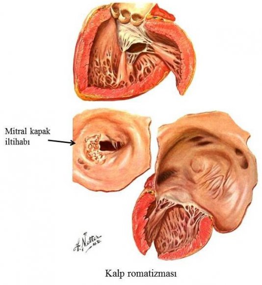 Kalp_romatizmas__.jpg
