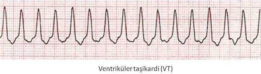 Ventriküler taşikardi (VT).jpg